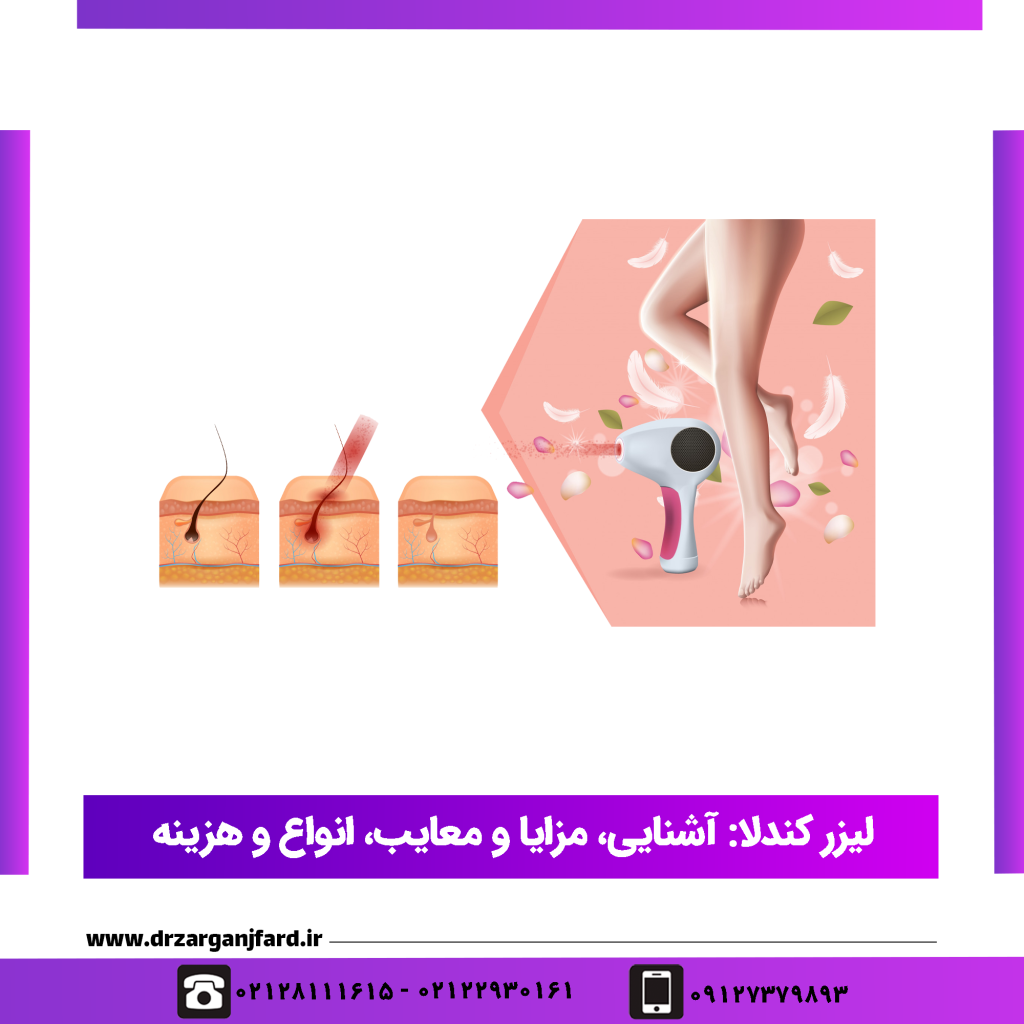 لیزر کندلا آشنایی مزایا و معایب انواع و هزینه