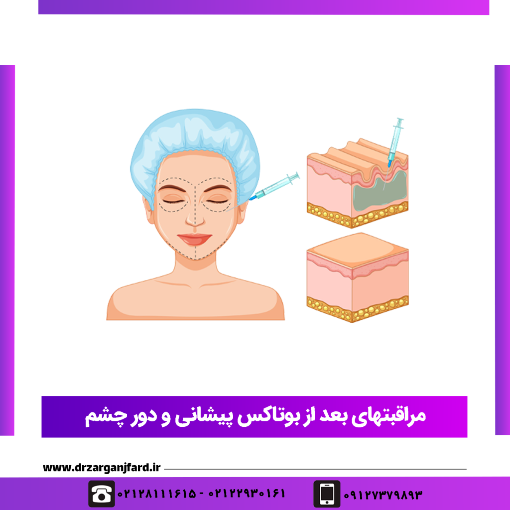 مراقبتهای بعد از بوتاکس پیشانی و دور چشم